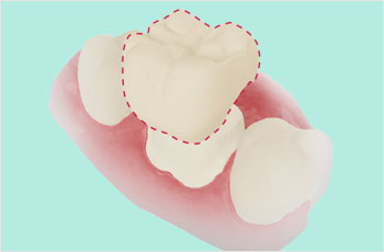 cadcam冠とはの画像