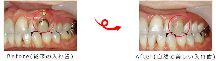 義歯(入れ歯)のビフォーアフター画像