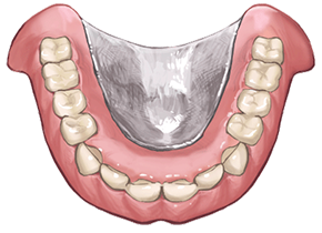 金属床入れ歯の画像