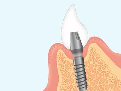 インプラント画像