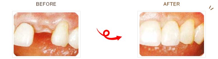 インプラントのビフォーアフター画像