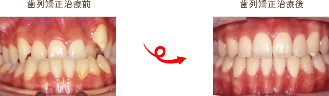 歯科矯正のビフォーアフター画像