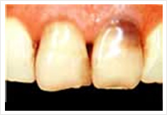 前歯部をジャケット冠治療前の画像