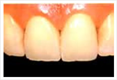 前歯部をジャケット冠治療後の画像