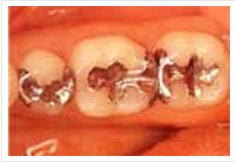 臼歯部をインレー治療前の画像