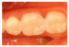 臼歯部をインレー治療後の画像