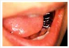 臼歯部をクラウン&インレー治療前の画像