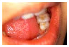 臼歯部をクラウン&インレー治療後の画像