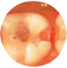 臼歯部をクラウン&インレー治療後の画像