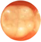 臼歯部をクラウン&インレー治療前の画像