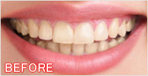 ホワイトニング前の画像