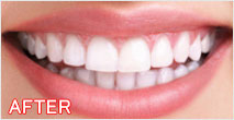 ホワイトニング後の画像